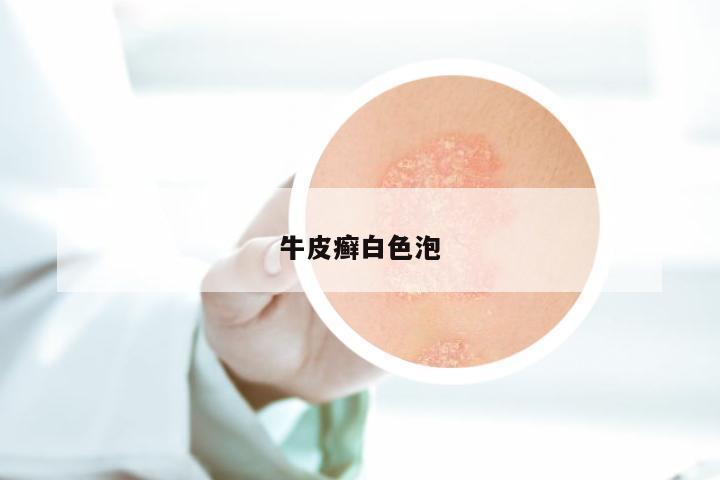 牛皮癣白色泡