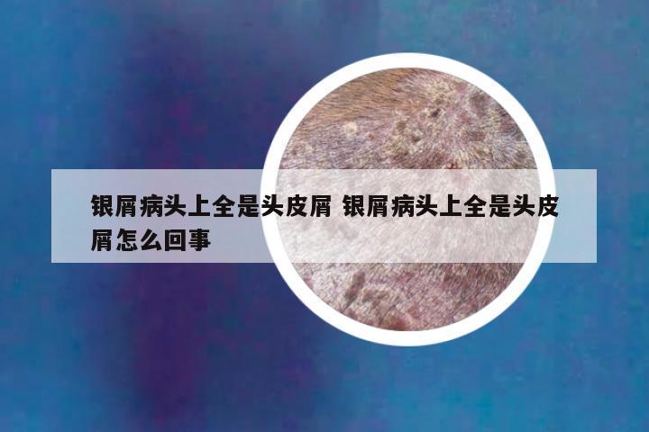 银屑病头上全是头皮屑 银屑病头上全是头皮屑怎么回事