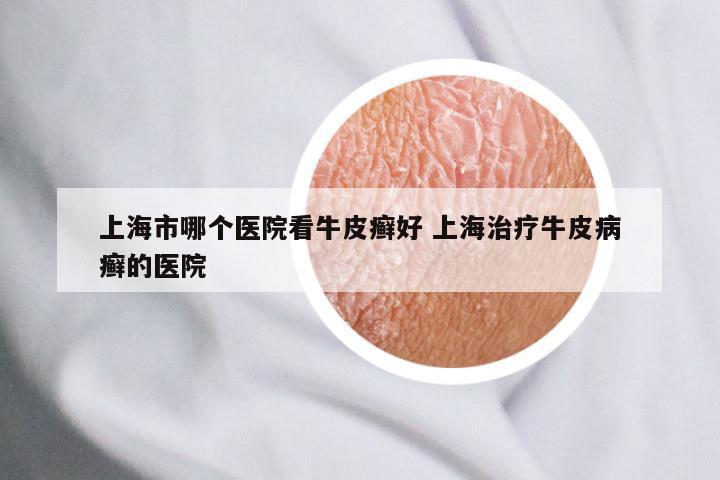 上海市哪个医院看牛皮癣好 上海治疗牛皮病癣的医院