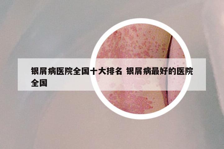 银屑病医院全国十大排名 银屑病最好的医院全国