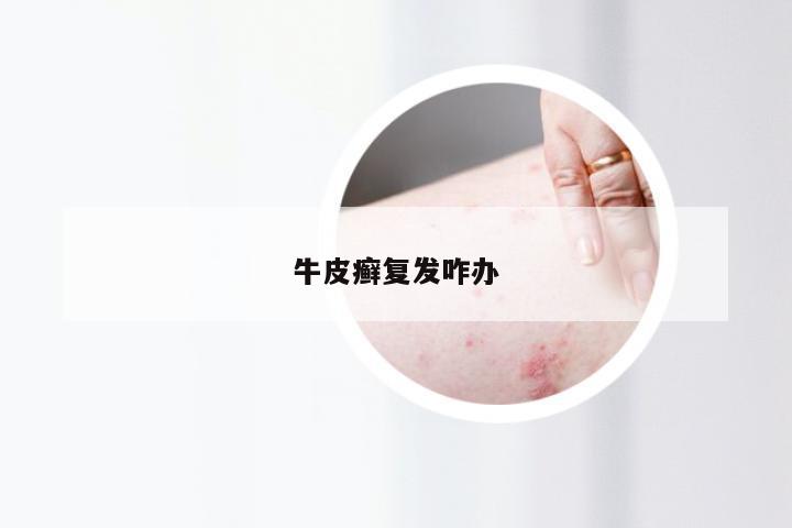 牛皮癣复发咋办