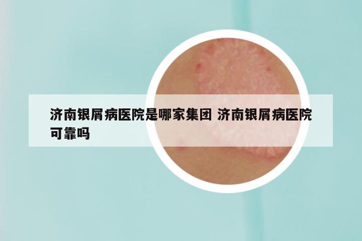 济南银屑病医院是哪家集团 济南银屑病医院可靠吗