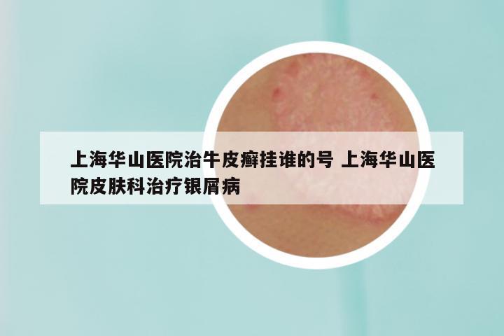上海华山医院治牛皮癣挂谁的号 上海华山医院皮肤科治疗银屑病