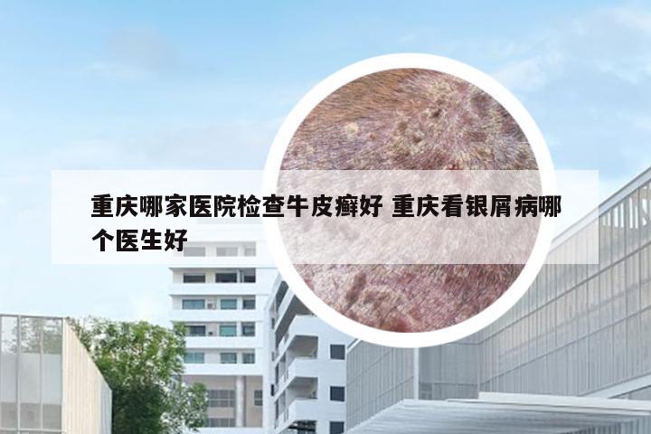 重庆哪家医院检查牛皮癣好 重庆看银屑病哪个医生好