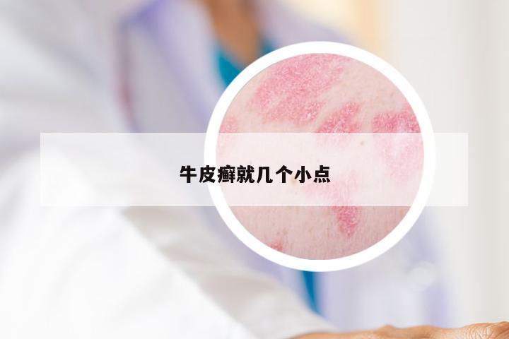 牛皮癣就几个小点