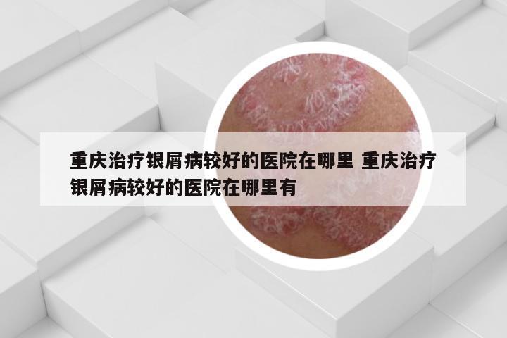 重庆治疗银屑病较好的医院在哪里 重庆治疗银屑病较好的医院在哪里有