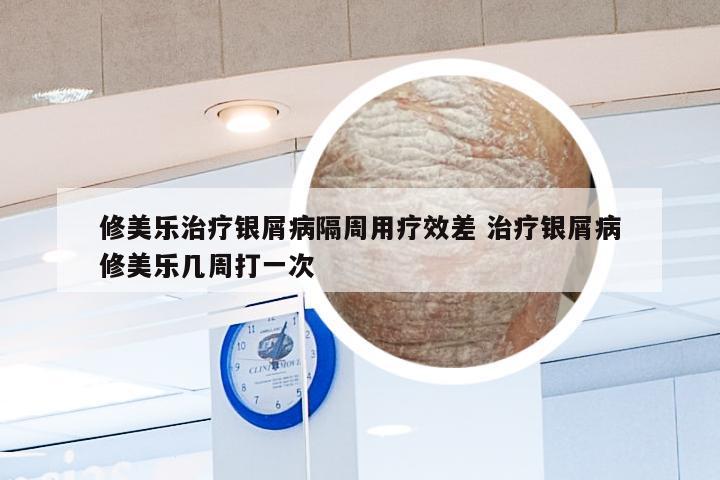 修美乐治疗银屑病隔周用疗效差 治疗银屑病修美乐几周打一次