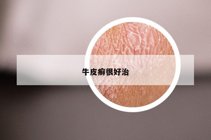 牛皮癣很好治