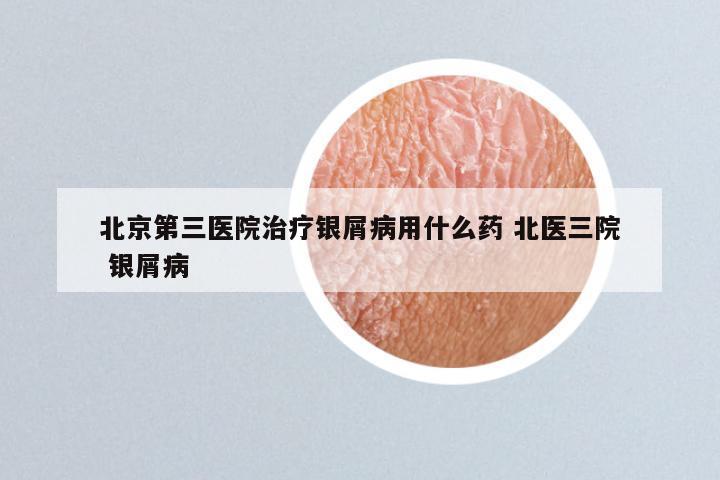 北京第三医院治疗银屑病用什么药 北医三院 银屑病