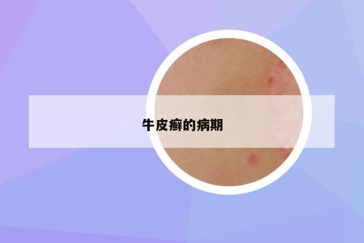 牛皮癣的病期