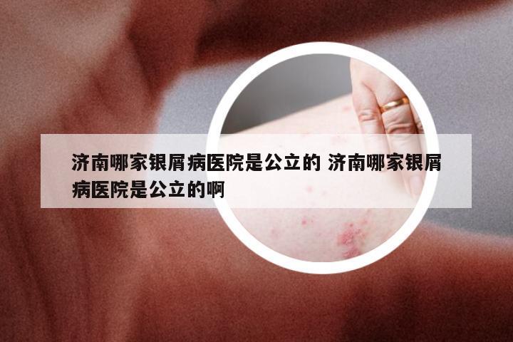 济南哪家银屑病医院是公立的 济南哪家银屑病医院是公立的啊