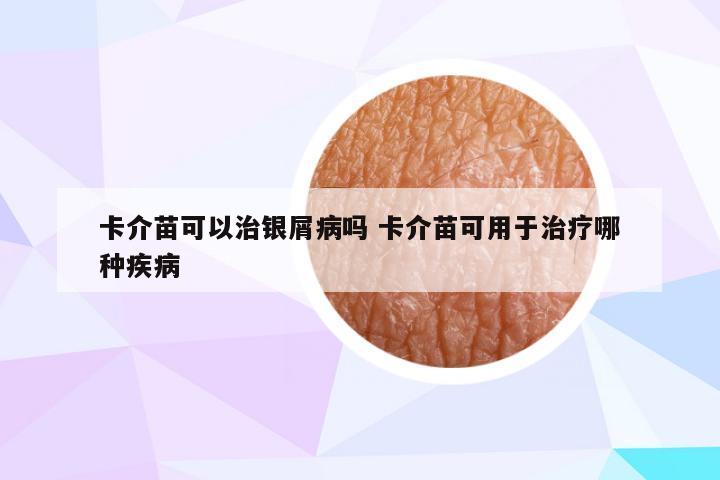 卡介苗可以治银屑病吗 卡介苗可用于治疗哪种疾病