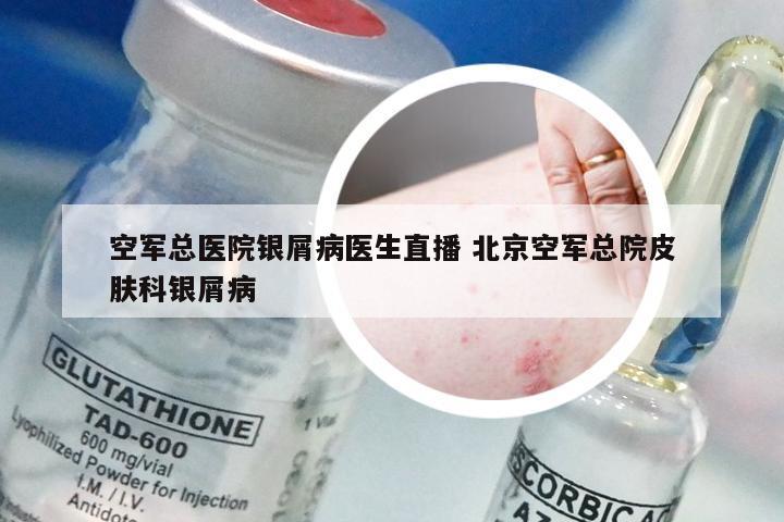 空军总医院银屑病医生直播 北京空军总院皮肤科银屑病