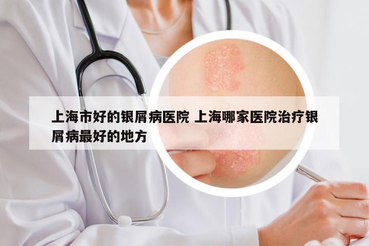 上海市好的银屑病医院 上海哪家医院治疗银屑病最好的地方