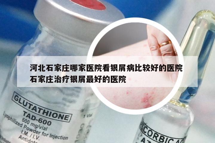 河北石家庄哪家医院看银屑病比较好的医院 石家庄治疗银屑最好的医院