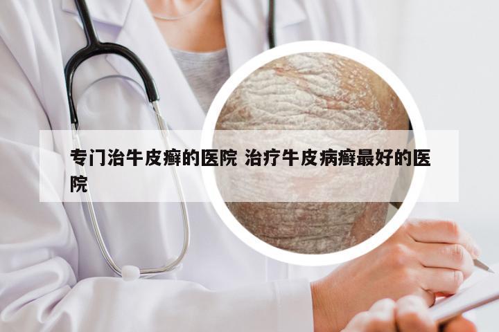 专门治牛皮癣的医院 治疗牛皮病癣最好的医院