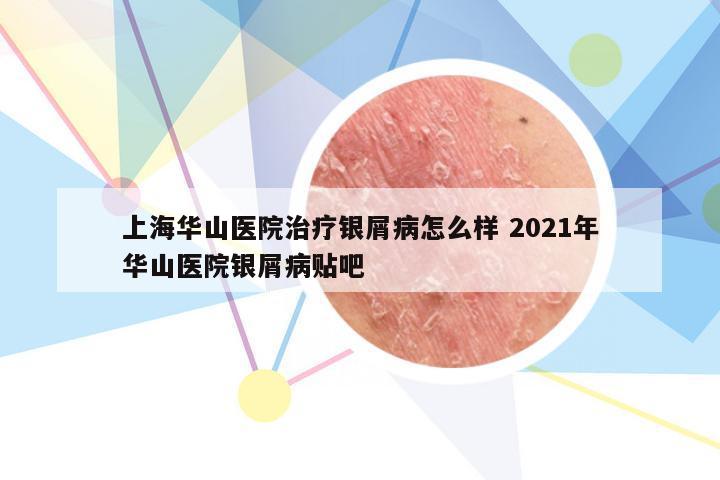 上海华山医院治疗银屑病怎么样 2021年华山医院银屑病贴吧