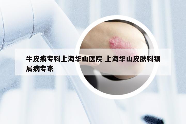 牛皮癣专科上海华山医院 上海华山皮肤科银屑病专家