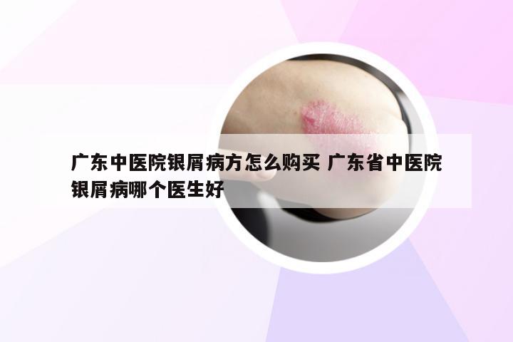 广东中医院银屑病方怎么购买 广东省中医院银屑病哪个医生好