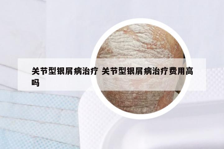 关节型银屑病治疗 关节型银屑病治疗费用高吗