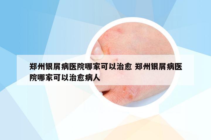 郑州银屑病医院哪家可以治愈 郑州银屑病医院哪家可以治愈病人