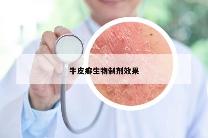 牛皮癣生物制剂效果