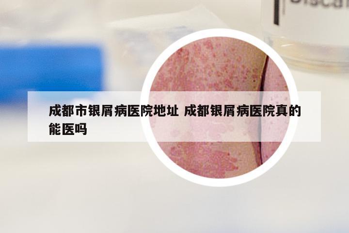 成都市银屑病医院地址 成都银屑病医院真的能医吗