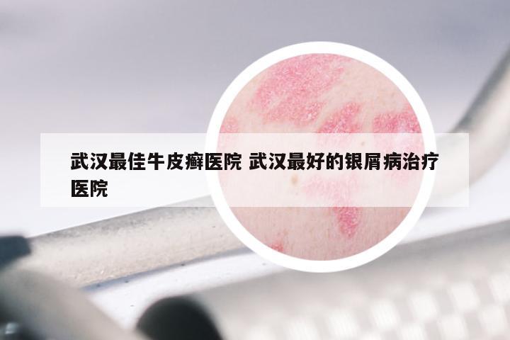 武汉最佳牛皮癣医院 武汉最好的银屑病治疗医院