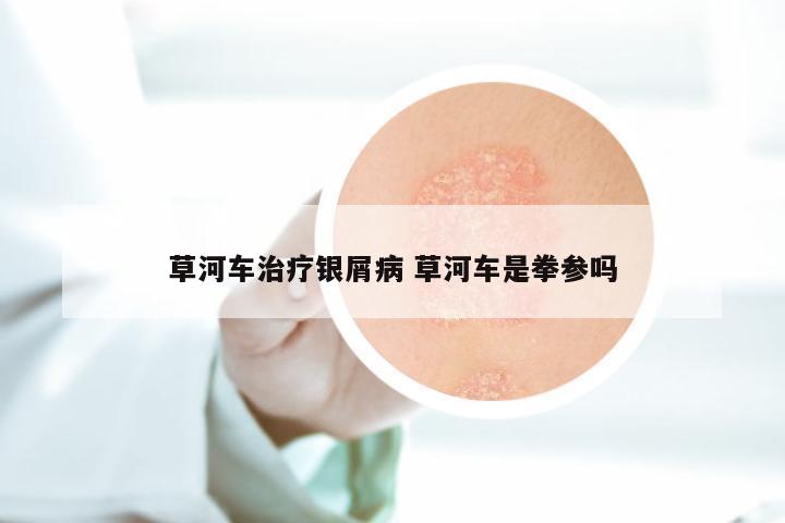 草河车治疗银屑病 草河车是拳参吗