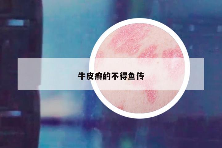 牛皮癣的不得鱼传