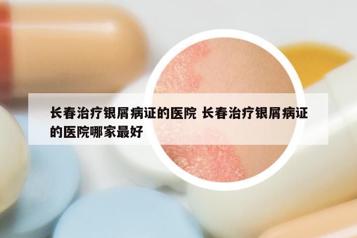 长春治疗银屑病证的医院 长春治疗银屑病证的医院哪家最好