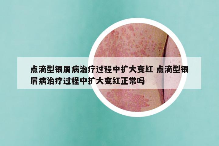点滴型银屑病治疗过程中扩大变红 点滴型银屑病治疗过程中扩大变红正常吗