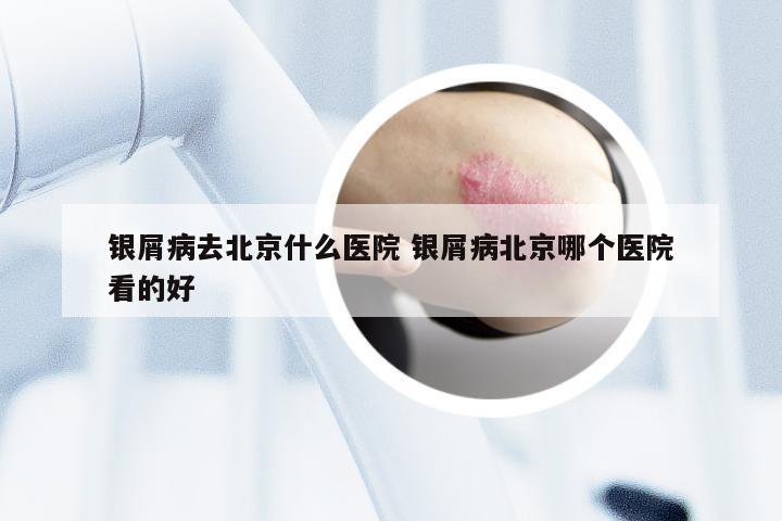 银屑病去北京什么医院 银屑病北京哪个医院看的好