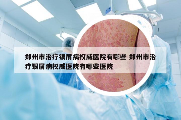 郑州市治疗银屑病权威医院有哪些 郑州市治疗银屑病权威医院有哪些医院