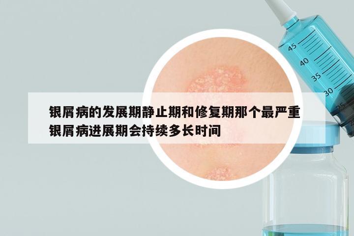 银屑病的发展期静止期和修复期那个最严重 银屑病进展期会持续多长时间