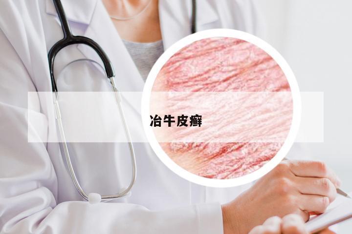 冶牛皮癣