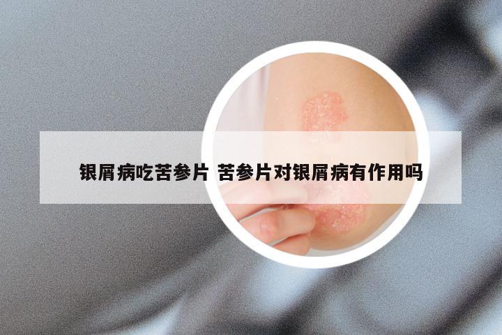 银屑病吃苦参片 苦参片对银屑病有作用吗