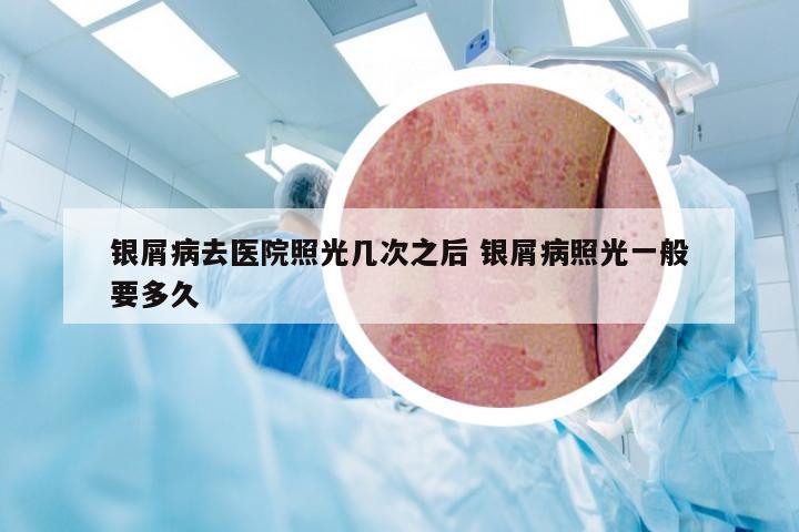 银屑病去医院照光几次之后 银屑病照光一般要多久