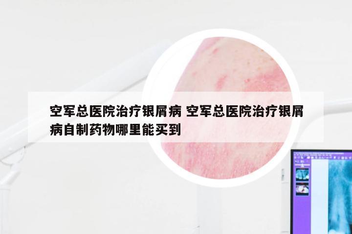 空军总医院治疗银屑病 空军总医院治疗银屑病自制药物哪里能买到
