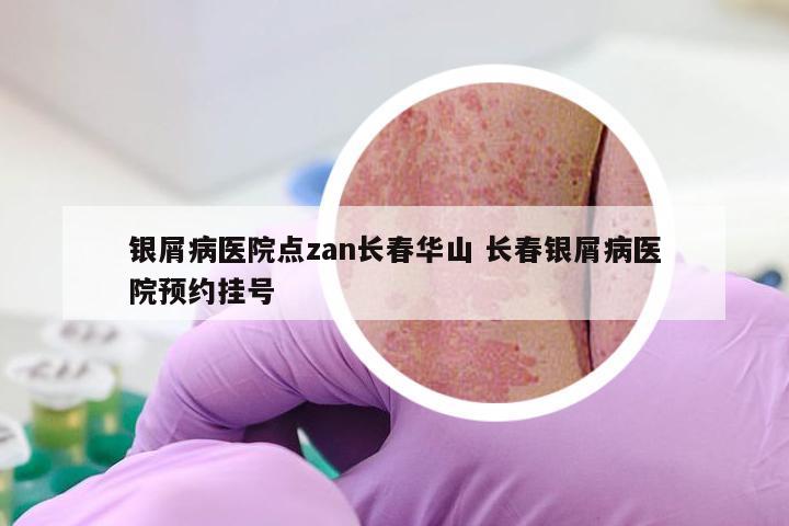 银屑病医院点zan长春华山 长春银屑病医院预约挂号