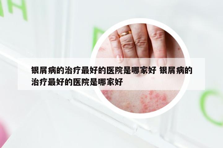 银屑病的治疗最好的医院是哪家好 银屑病的治疗最好的医院是哪家好