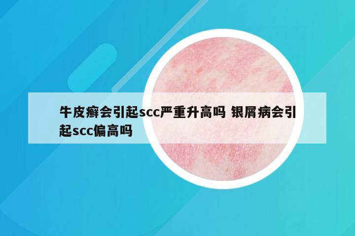 牛皮癣会引起scc严重升高吗 银屑病会引起scc偏高吗