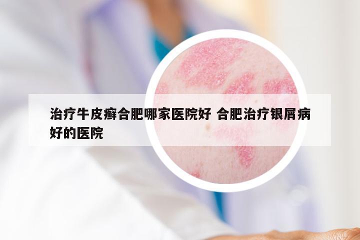 治疗牛皮癣合肥哪家医院好 合肥治疗银屑病好的医院