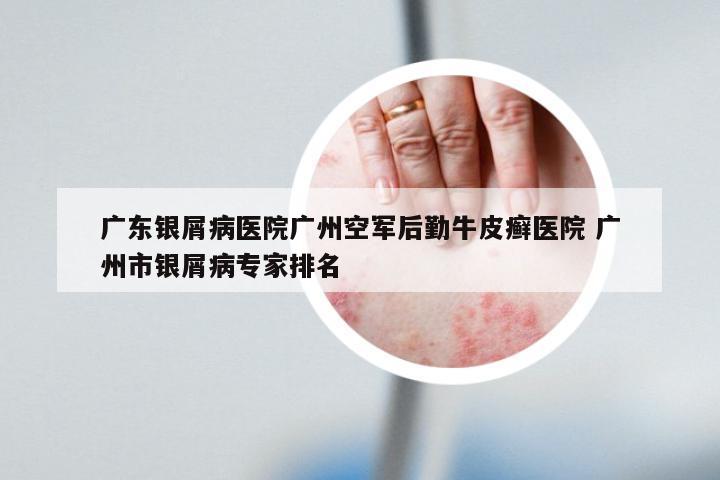 广东银屑病医院广州空军后勤牛皮癣医院 广州市银屑病专家排名