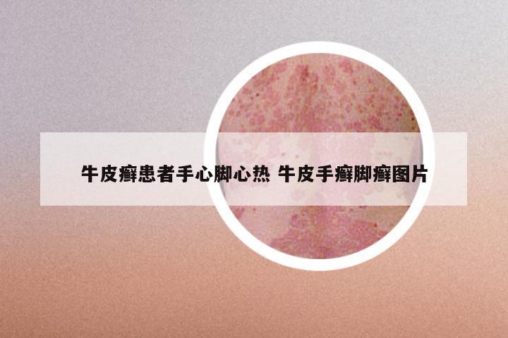 牛皮癣患者手心脚心热 牛皮手癣脚癣图片
