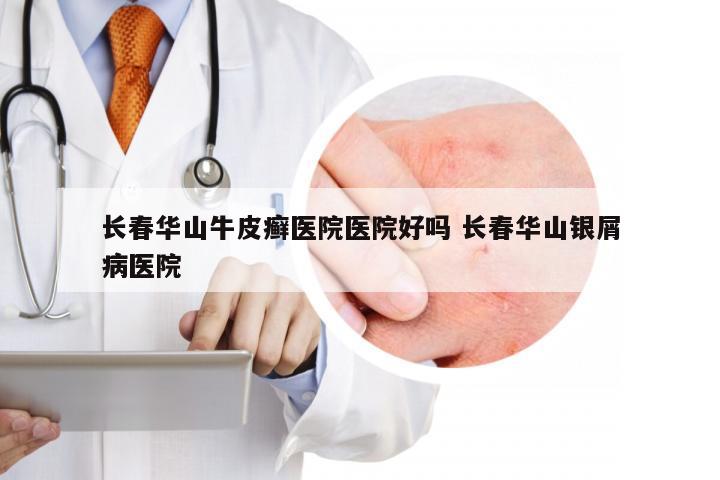 长春华山牛皮癣医院医院好吗 长春华山银屑病医院