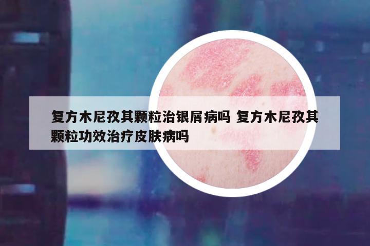 复方木尼孜其颗粒治银屑病吗 复方木尼孜其颗粒功效治疗皮肤病吗