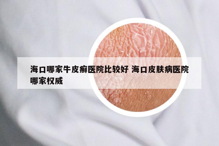 海口哪家牛皮癣医院比较好 海口皮肤病医院哪家权威