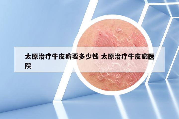 太原治疗牛皮癣要多少钱 太原治疗牛皮癜医院
