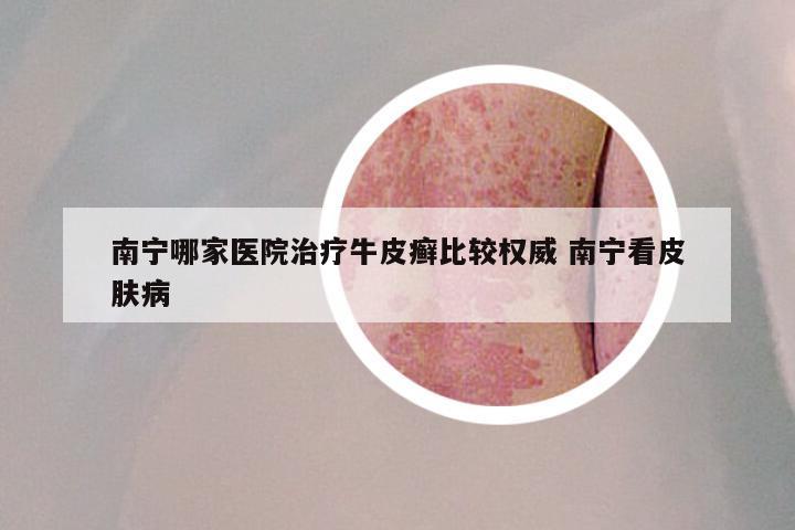 南宁哪家医院治疗牛皮癣比较权威 南宁看皮肤病